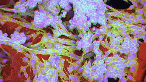 Confocal image of an injectable tumor cell infused anti-cancer cryogel vaccine_Sidi Bencherif
